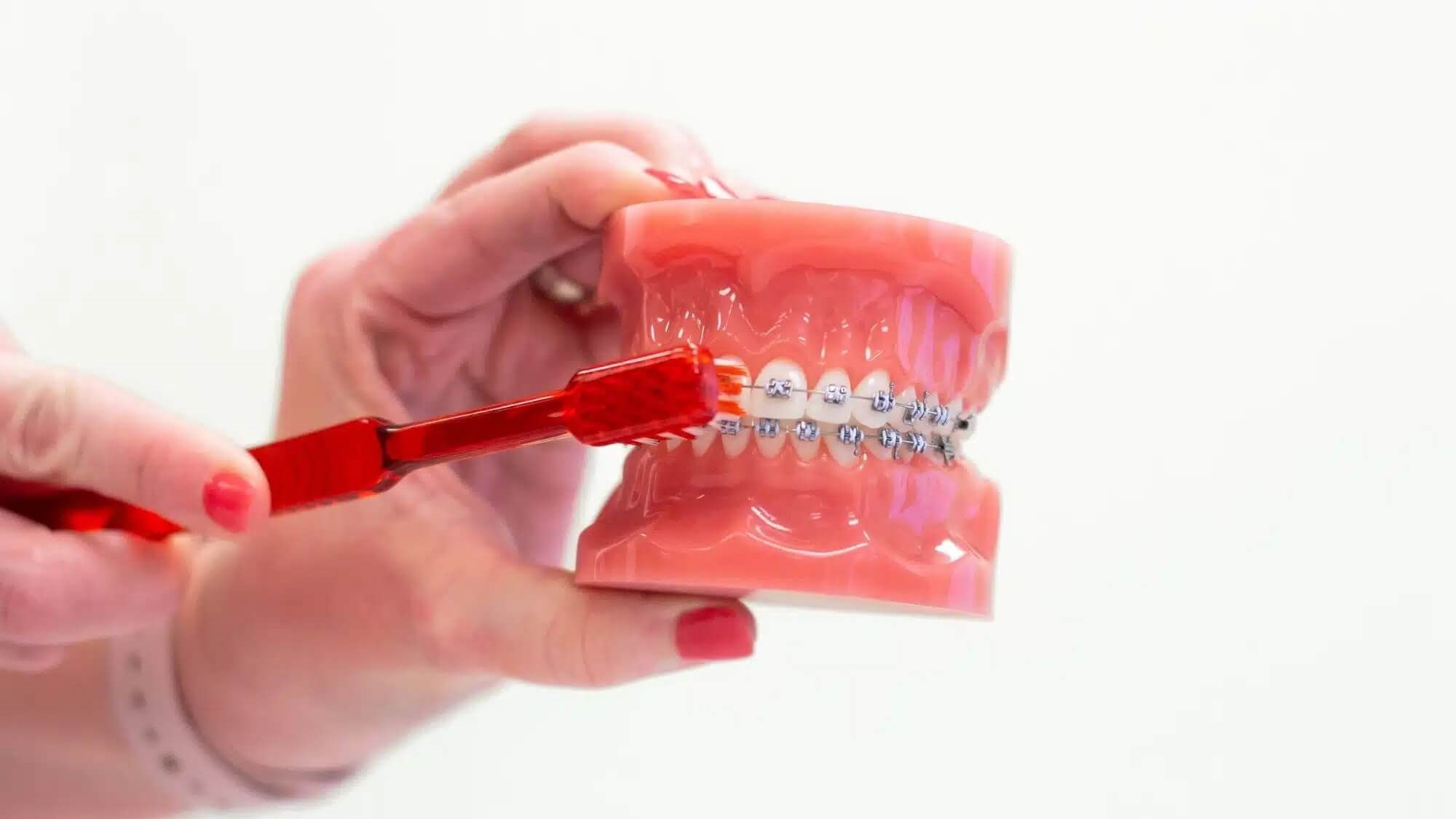 Tips for Brushing with Braces